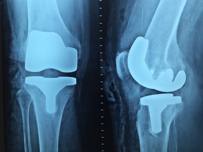 変形性膝関節症の看護計画・問題｜手術前/手術後/リハビリ